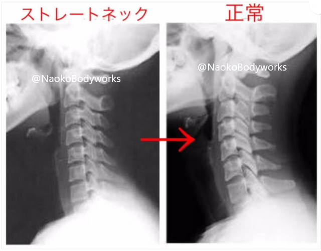 猫背、ストレートネック、背骨の歪み、諦めていませんか?